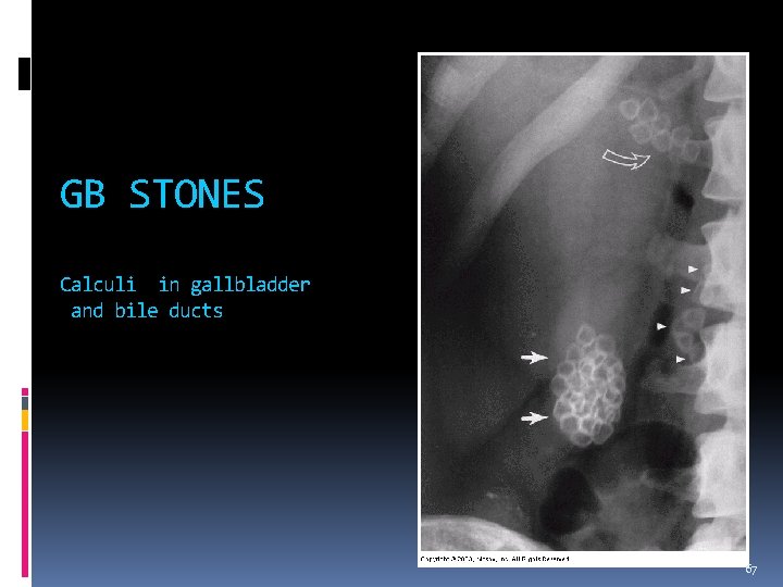 GB STONES Calculi in gallbladder and bile ducts 67 