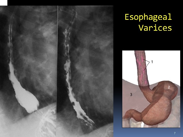 Esophageal Varices 7 