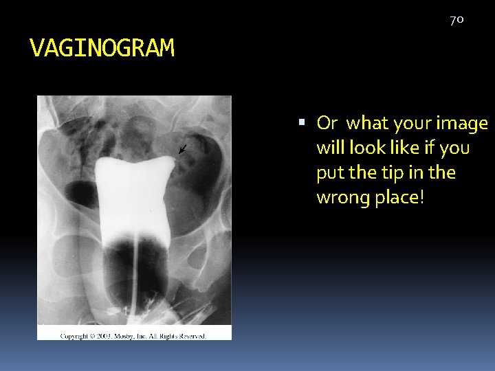 70 VAGINOGRAM Or what your image will look like if you put the tip