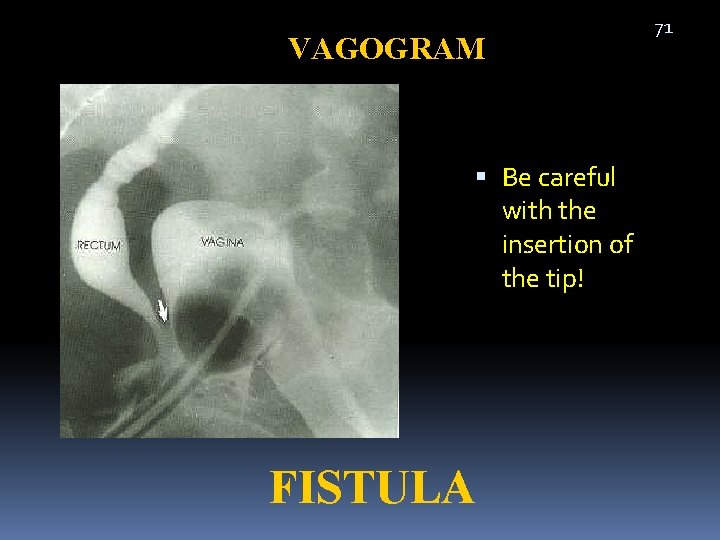 VAGOGRAM Be careful with the insertion of the tip! FISTULA 71 