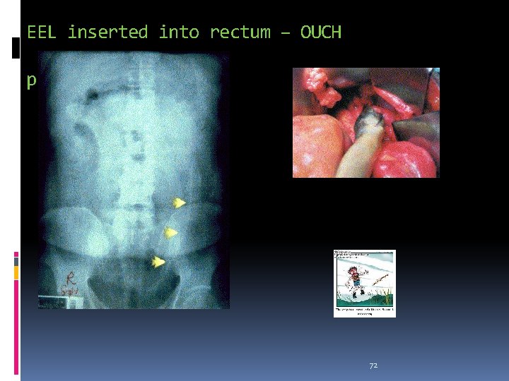 EEL inserted into rectum – OUCH perforating bowel 72 