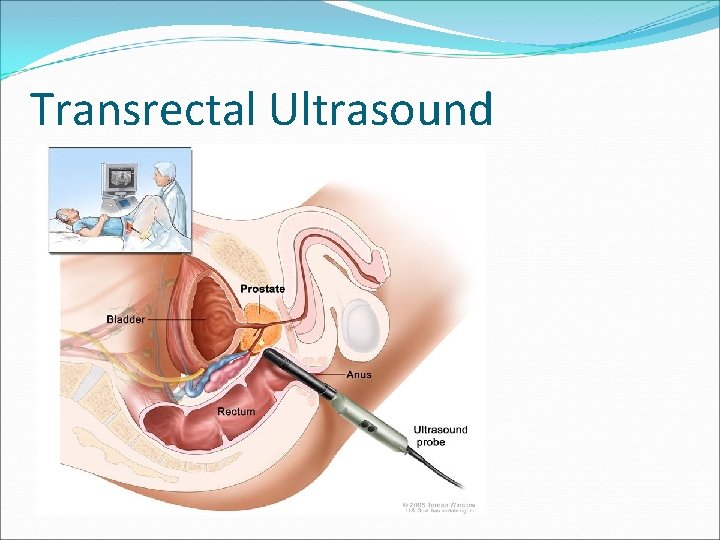 Transrectal Ultrasound 