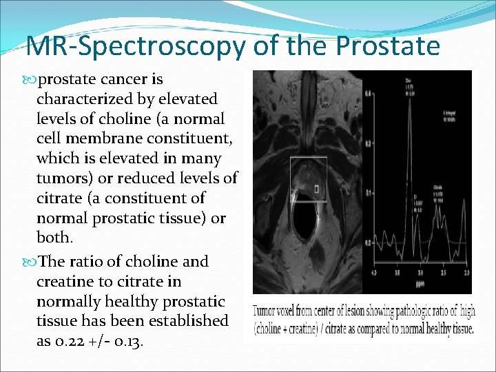 MR‐Spectroscopy of the Prostate prostate cancer is characterized by elevated levels of choline (a