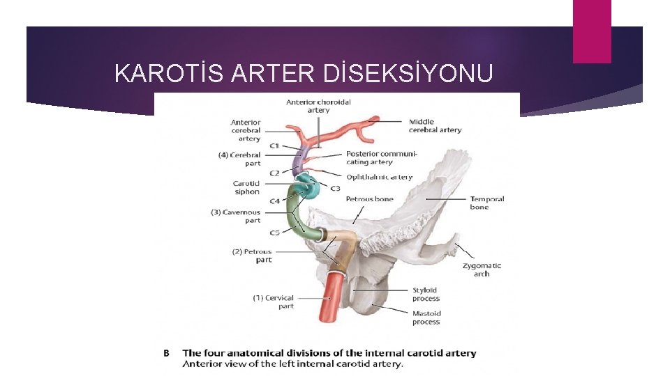 KAROTİS ARTER DİSEKSİYONU 