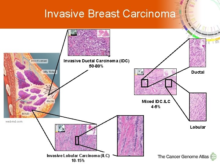 Invasive Breast Carcinoma Invasive Ductal Carcinoma (IDC) 50 -80% Ductal Mixed IDC. ILC 4