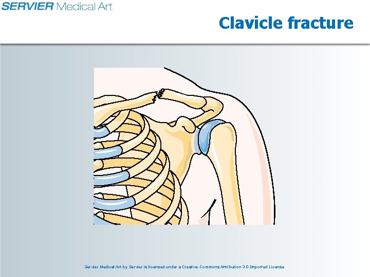 Clavicle fracture Servier Medical Art by Servier is licensed under a Creative Commons Attribution Clavicle fracture Servier Medical Art by Servier is licensed under a Creative Commons Attribution
