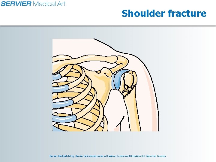 Shoulder fracture Servier Medical Art by Servier is licensed under a Creative Commons Attribution Shoulder fracture Servier Medical Art by Servier is licensed under a Creative Commons Attribution