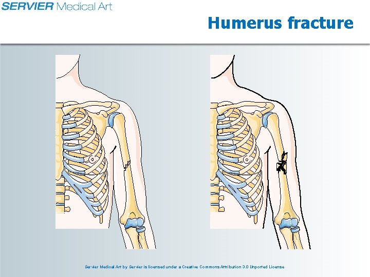 Humerus fracture Servier Medical Art by Servier is licensed under a Creative Commons Attribution Humerus fracture Servier Medical Art by Servier is licensed under a Creative Commons Attribution