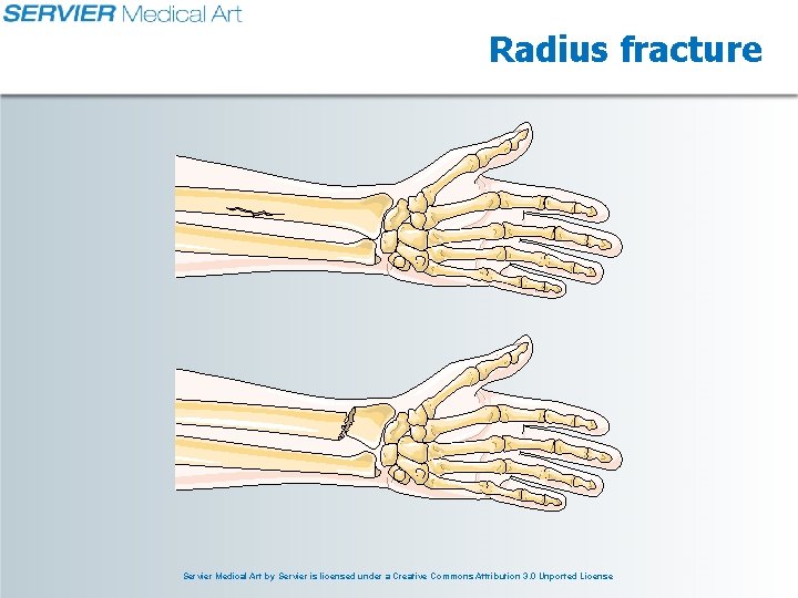 Radius fracture Servier Medical Art by Servier is licensed under a Creative Commons Attribution Radius fracture Servier Medical Art by Servier is licensed under a Creative Commons Attribution