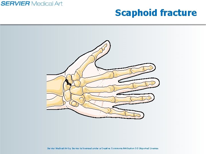 Scaphoid fracture Servier Medical Art by Servier is licensed under a Creative Commons Attribution Scaphoid fracture Servier Medical Art by Servier is licensed under a Creative Commons Attribution