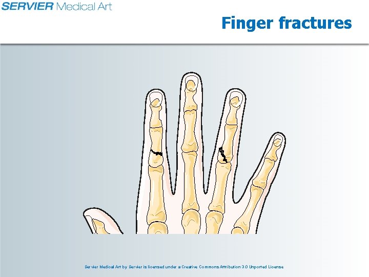 Finger fractures Servier Medical Art by Servier is licensed under a Creative Commons Attribution Finger fractures Servier Medical Art by Servier is licensed under a Creative Commons Attribution