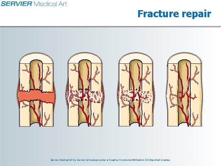 Fracture repair Servier Medical Art by Servier is licensed under a Creative Commons Attribution Fracture repair Servier Medical Art by Servier is licensed under a Creative Commons Attribution