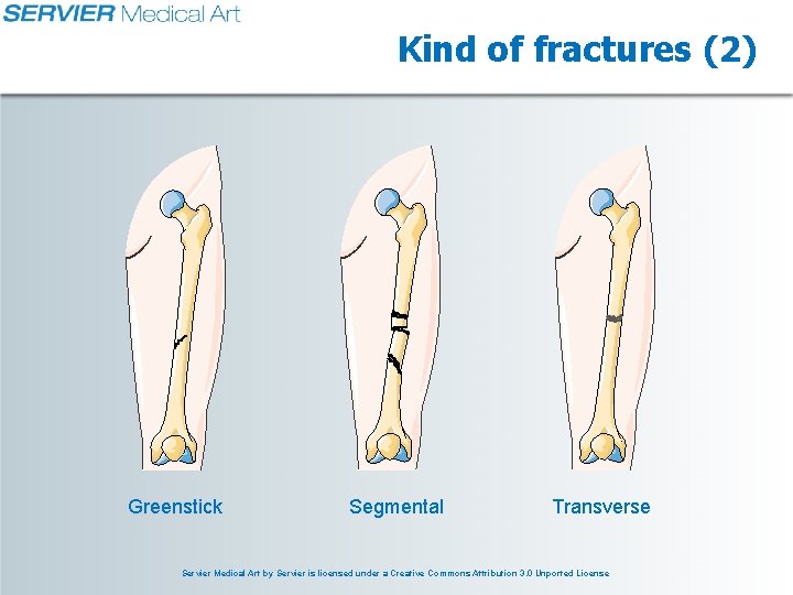 Kind of fractures (2) Greenstick Segmental Transverse Servier Medical Art by Servier is licensed Kind of fractures (2) Greenstick Segmental Transverse Servier Medical Art by Servier is licensed