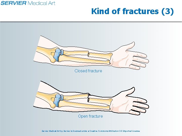 Kind of fractures (3) Closed fracture Open fracture Servier Medical Art by Servier is Kind of fractures (3) Closed fracture Open fracture Servier Medical Art by Servier is