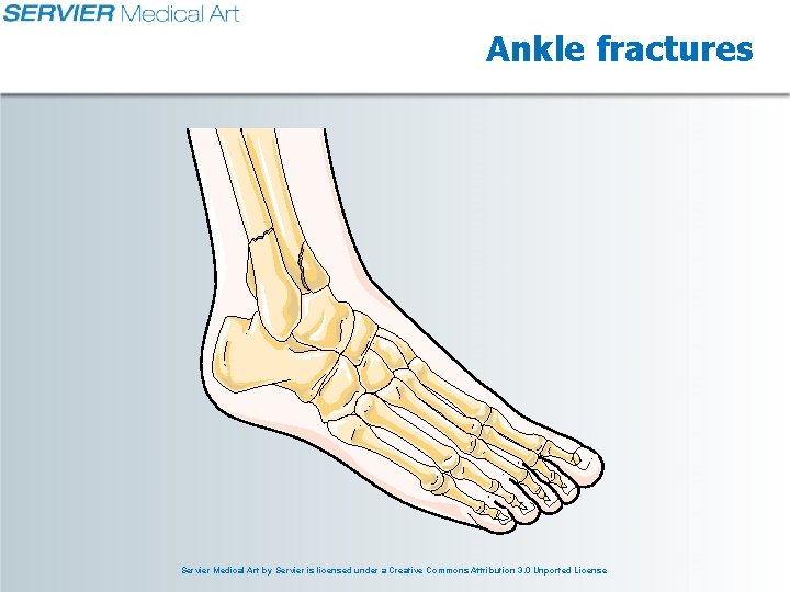 Ankle fractures Servier Medical Art by Servier is licensed under a Creative Commons Attribution Ankle fractures Servier Medical Art by Servier is licensed under a Creative Commons Attribution