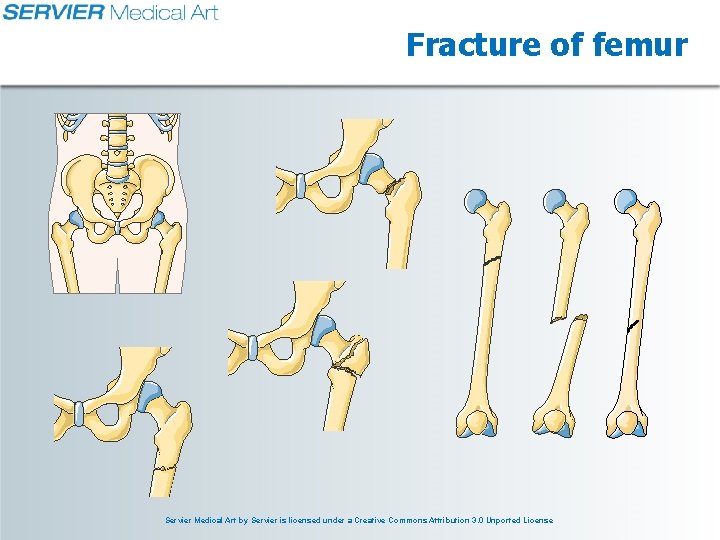 Fracture of femur Servier Medical Art by Servier is licensed under a Creative Commons Fracture of femur Servier Medical Art by Servier is licensed under a Creative Commons