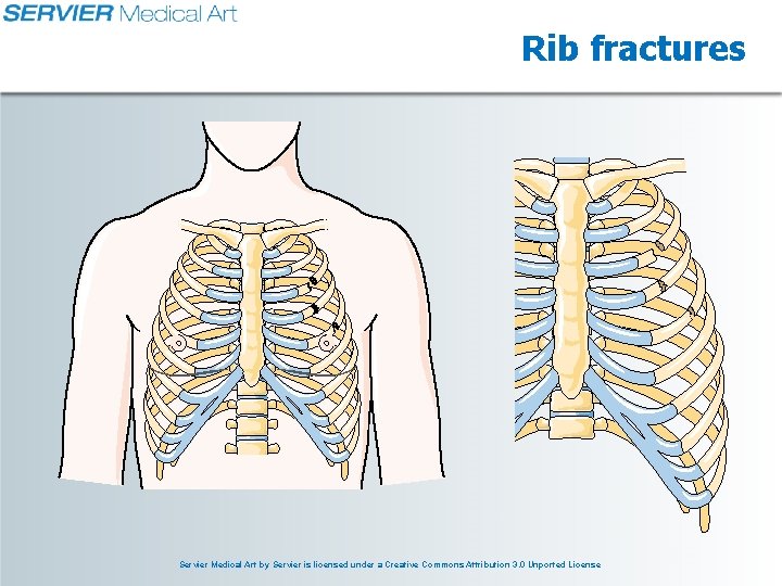 Rib fractures Servier Medical Art by Servier is licensed under a Creative Commons Attribution Rib fractures Servier Medical Art by Servier is licensed under a Creative Commons Attribution