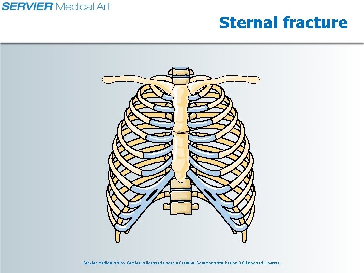 Sternal fracture Servier Medical Art by Servier is licensed under a Creative Commons Attribution Sternal fracture Servier Medical Art by Servier is licensed under a Creative Commons Attribution