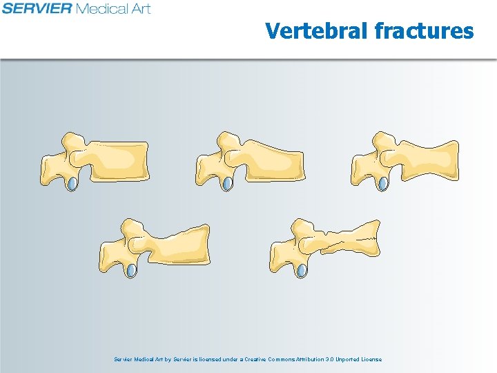 Vertebral fractures Servier Medical Art by Servier is licensed under a Creative Commons Attribution Vertebral fractures Servier Medical Art by Servier is licensed under a Creative Commons Attribution