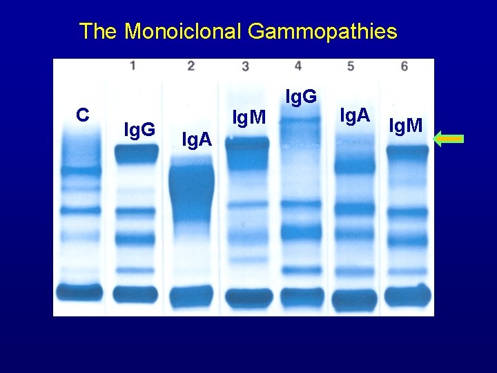 The Monoiclonal Gammopathies C Ig. G Ig. M Ig. A Ig. G Ig. A