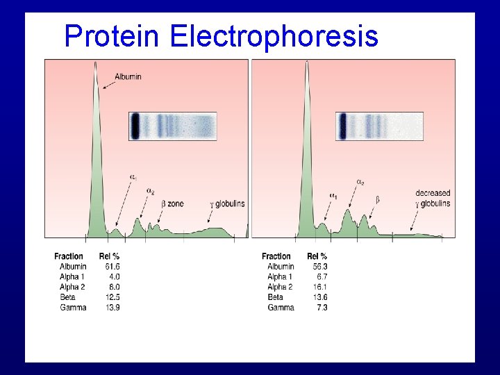 Protein Electrophoresis 