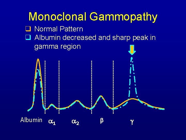 Monoclonal Gammopathy q Normal Pattern q Albumin decreased and sharp peak in gamma region
