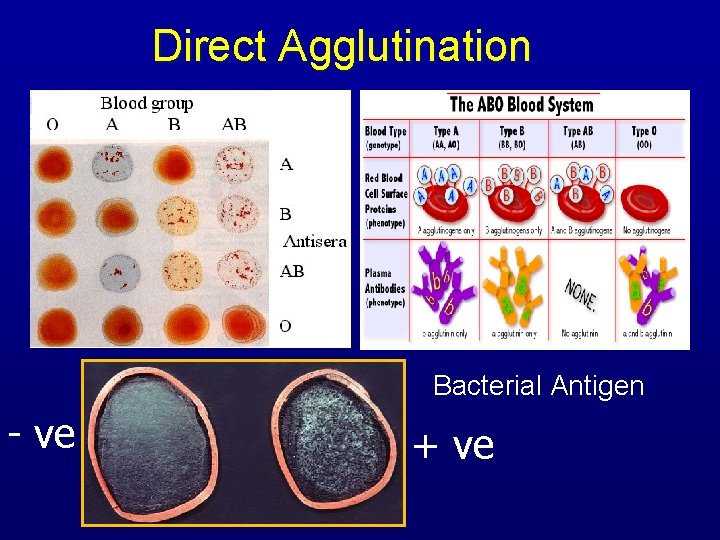 Direct Agglutination Bacterial Antigen - ve + ve 