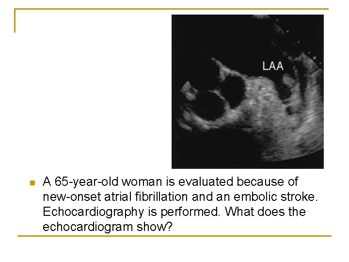 n A 65 -year-old woman is evaluated because of new-onset atrial fibrillation and an