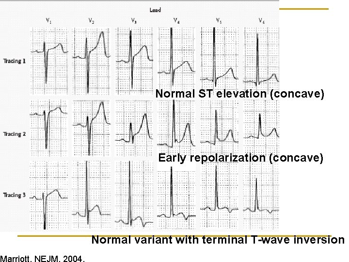 Marriott, NEJM, 2004. Normal ST elevation (concave) Early repolarization (concave) Normal variant with terminal