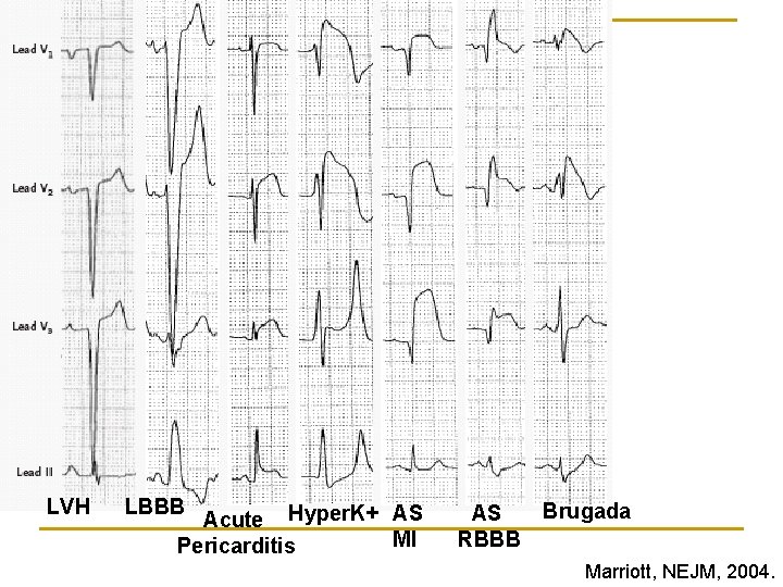 LVH LBBB Acute Hyper. K+ AS MI Pericarditis AS RBBB Brugada Marriott, NEJM, 2004.