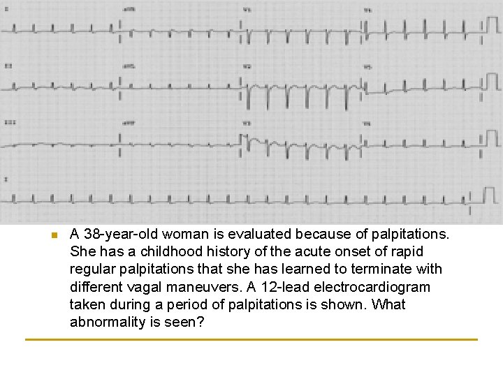 n A 38 -year-old woman is evaluated because of palpitations. She has a childhood