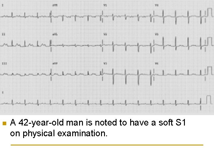 n A 42 -year-old man is noted to have a soft S 1 on