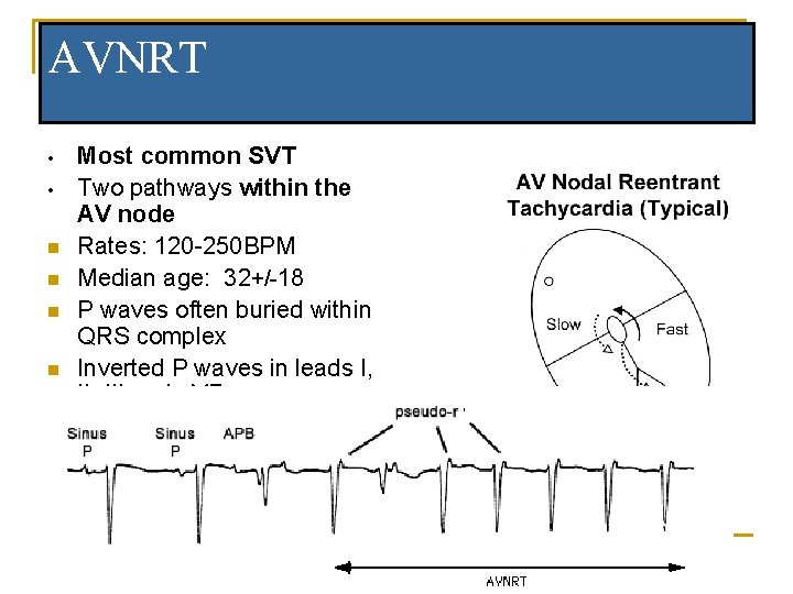 AVNRT • • n n n Most common SVT Two pathways within the AV