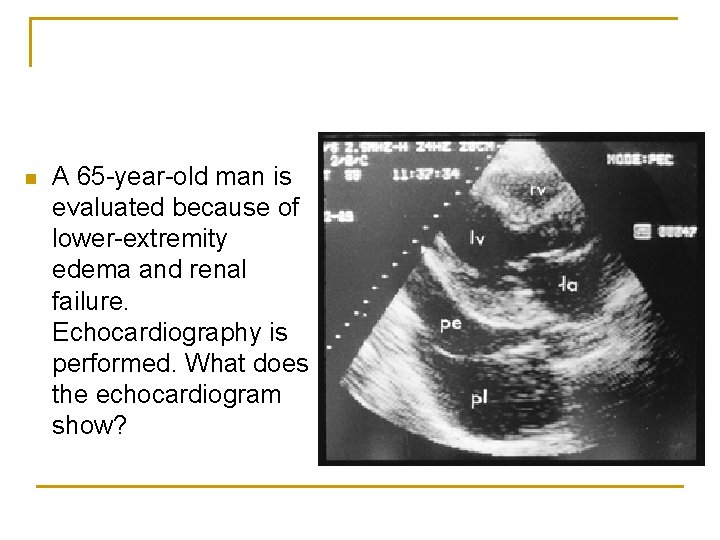 n A 65 -year-old man is evaluated because of lower-extremity edema and renal failure.