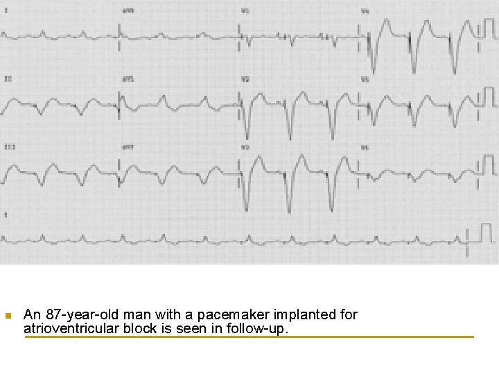 n An 87 -year-old man with a pacemaker implanted for atrioventricular block is seen