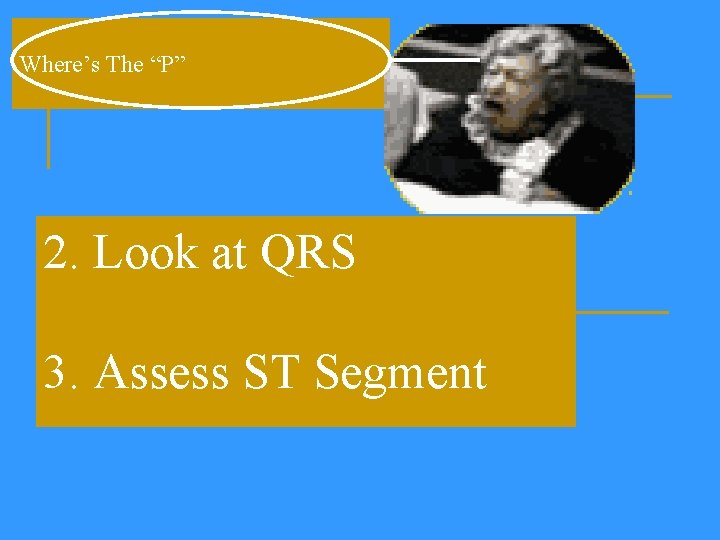 Where’s The “P” 2. Look at QRS 3. Assess ST Segment 