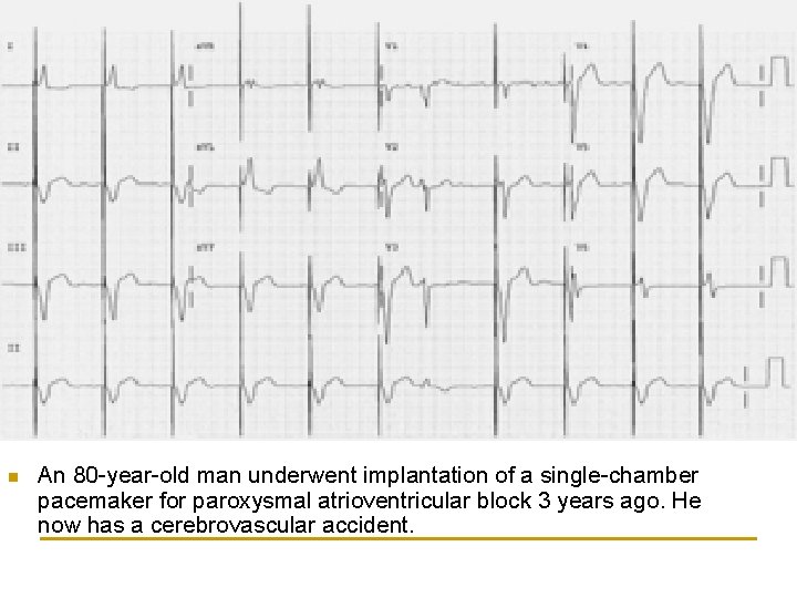 n An 80 -year-old man underwent implantation of a single-chamber pacemaker for paroxysmal atrioventricular