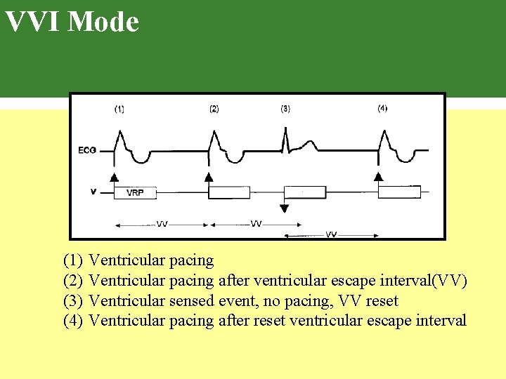 VVI Mode (1) (2) (3) (4) Ventricular pacing after ventricular escape interval(VV) Ventricular sensed