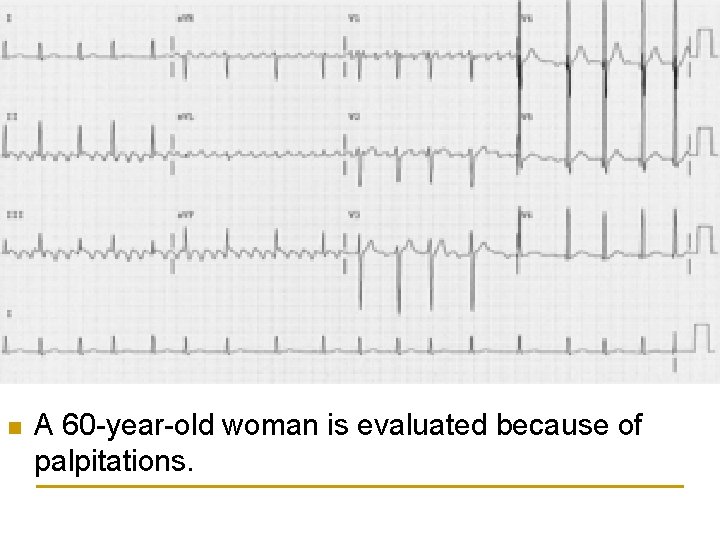 n A 60 -year-old woman is evaluated because of palpitations. 