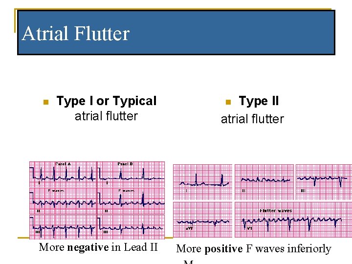 Atrial Flutter n Type I or Typical atrial flutter Type II atrial flutter n