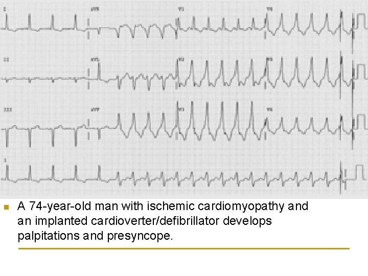 n A 74 -year-old man with ischemic cardiomyopathy and an implanted cardioverter/defibrillator develops palpitations