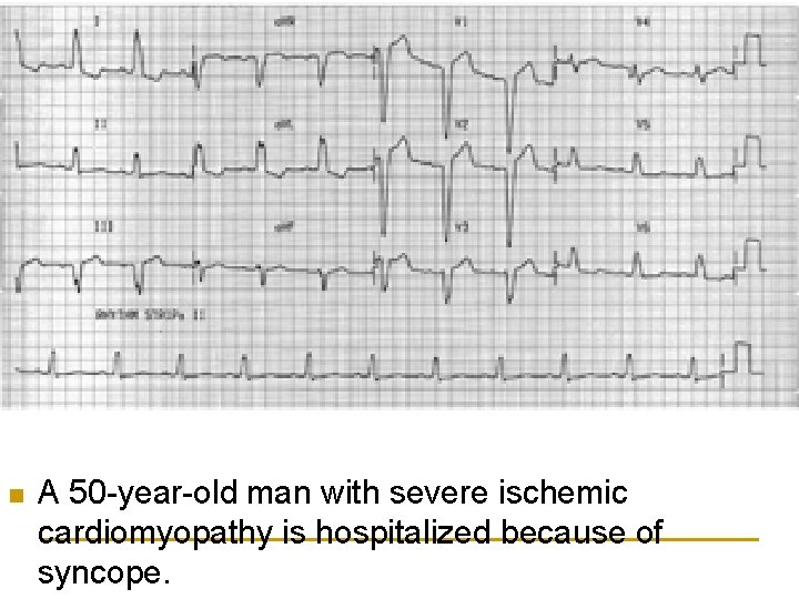 n A 50 -year-old man with severe ischemic cardiomyopathy is hospitalized because of syncope.