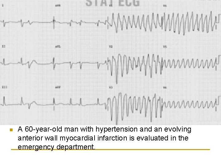 n A 60 -year-old man with hypertension and an evolving anterior wall myocardial infarction