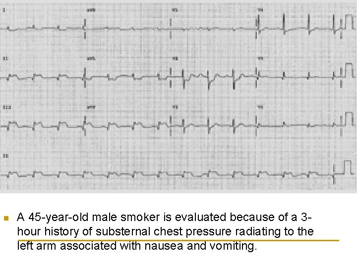 n A 45 -year-old male smoker is evaluated because of a 3 hour history