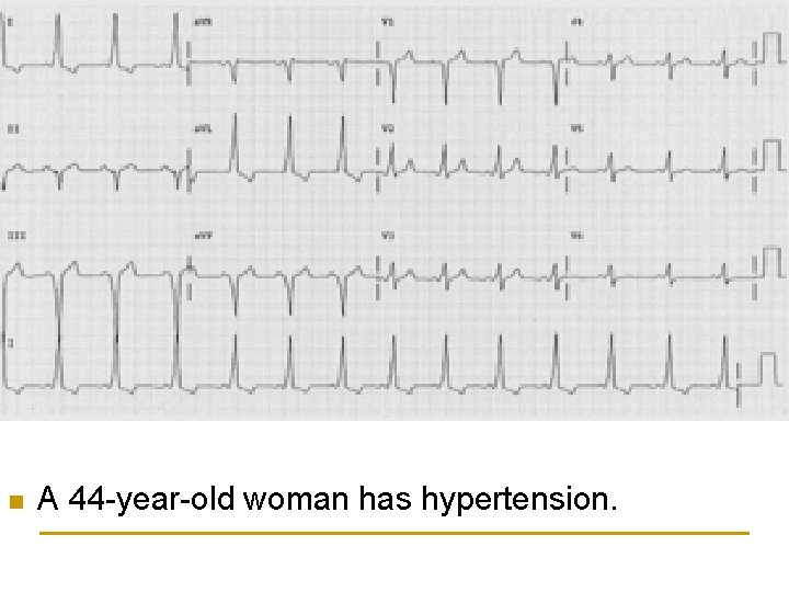 n A 44 -year-old woman has hypertension. 