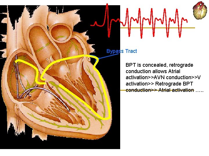 Bypass Tract BPT is concealed, retrograde conduction allows Atrial activation>>AVN conduction>>V activation>> Retrograde BPT
