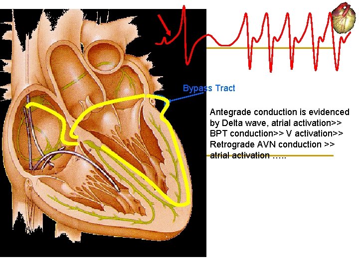 Bypass Tract Antegrade conduction is evidenced by Delta wave, atrial activation>> BPT conduction>> V
