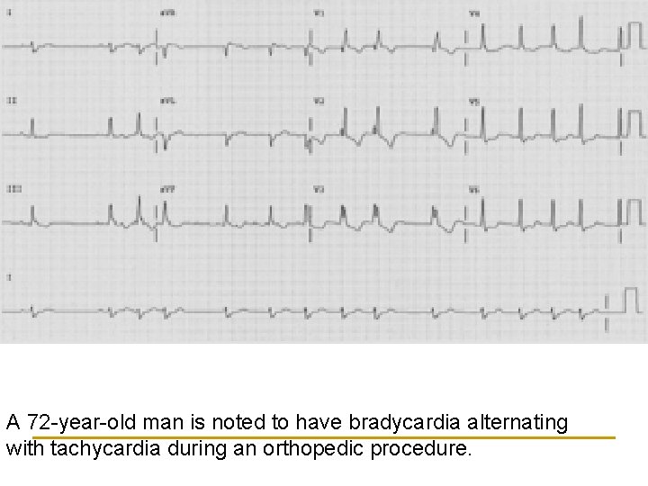 A 72 -year-old man is noted to have bradycardia alternating with tachycardia during an