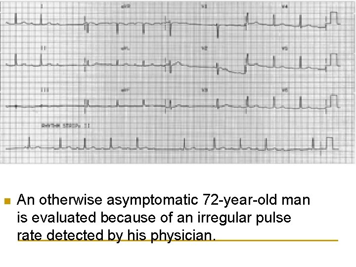 n An otherwise asymptomatic 72 -year-old man is evaluated because of an irregular pulse