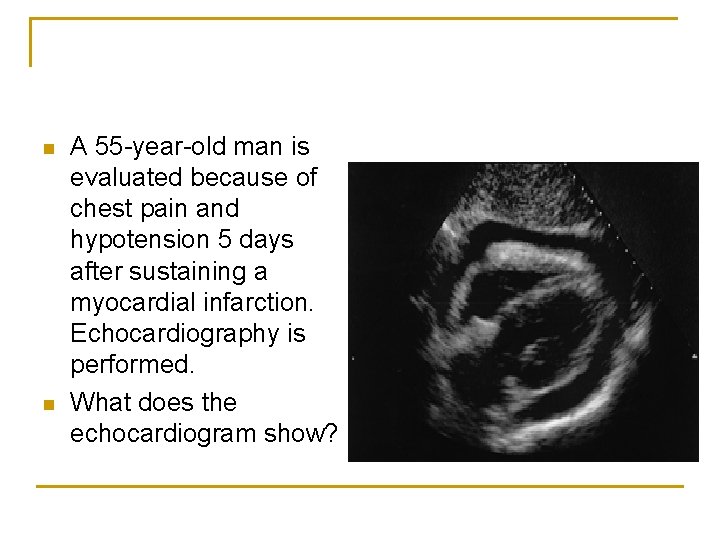 n n A 55 -year-old man is evaluated because of chest pain and hypotension